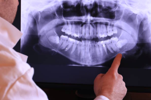 Best Emergency Dental Care for Sports Injuries in Apalachin, NY